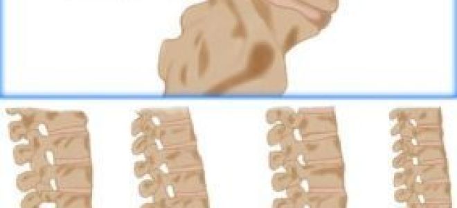 Листез позвоночника: классификация и симптомы болезни