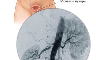 Нефрогенная артериальная гипертензия: симптомы и лечение