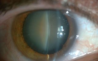Послеоперационный период после замены хрусталика глаза при катаракте