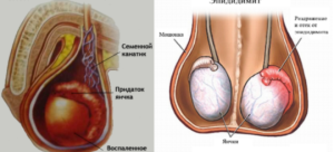 Увеличение мошонки у пожилых мужчин: причины и лечение