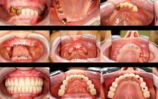 Протезирование зубо по методу all-on-4 в в медицинских клиниках литвы: преимущества процедуры