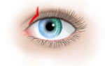 Причины и диагностика кератита глаза – симптомы, лечение и профилактика