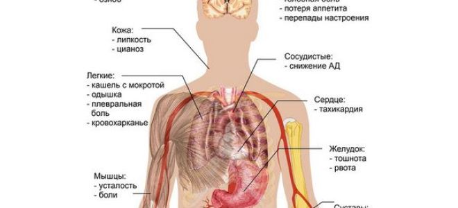 Как наступает смерть от пневмонии – причины, последствия и как избежать