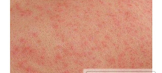 Опрелости у лежачих больных: причины возникновения и симптомы, методы лечения и профилактики