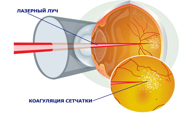 Диабетическая ретинопатия: симптомы и лечение