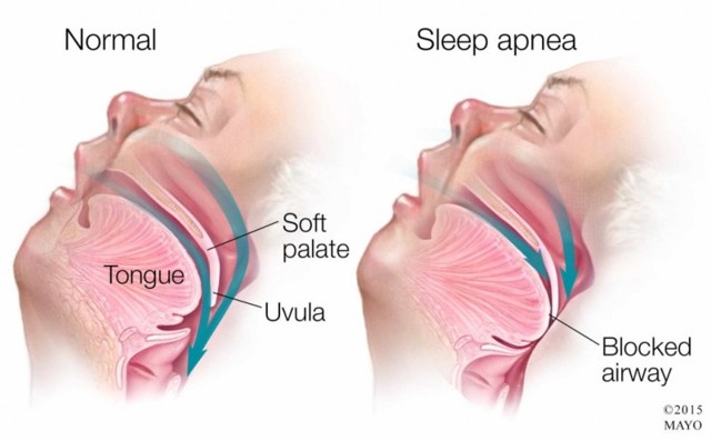 Апноэ во сне: причины развития и варианты избавления от недуга