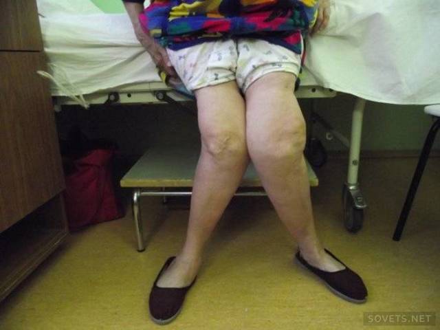 Лечение артроза коленного сустава в домашних условиях: гимнастика и народные методы