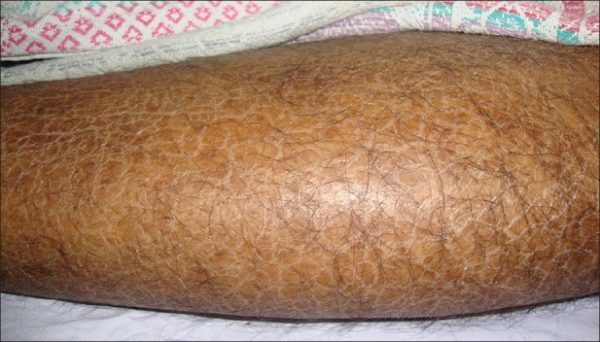 Как лечить ксероз кожи в пожилом возрасте: медикаменты, диета и народные методы