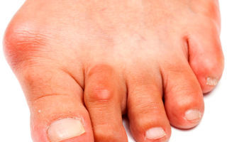 Симптомы бурсита большого пальца ноги: болевые ощущения и отечность конечностей