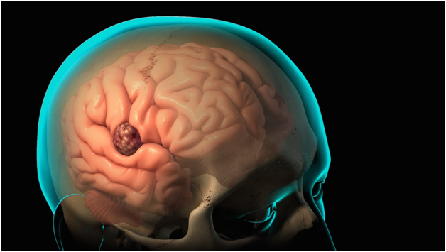 Старческая энцефалопатия головного мозга - причины и лечение разными методиками