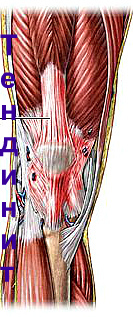 Причины развития тендита сухожилий коленного сустава: большие физические нагрузки и травмы