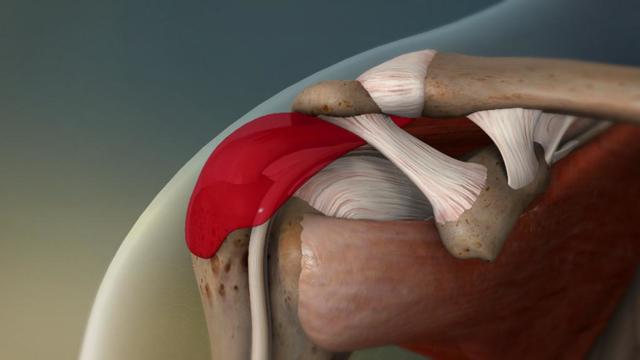 Причины развития субакромиального бурсита плечевого сустава: профессии подверженные патологии