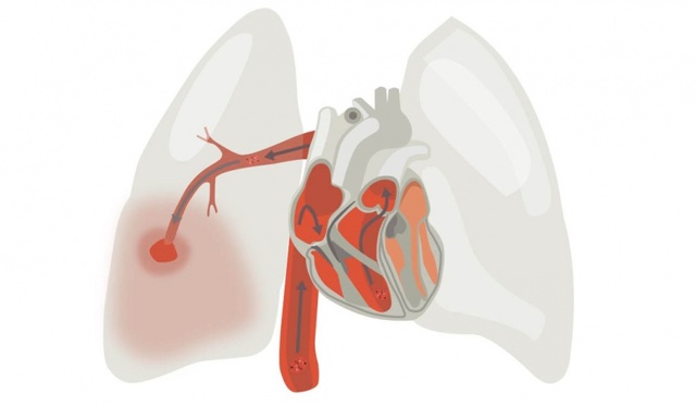 Ишемическая болезнь сердца у пожилых: симптомы и лечение
