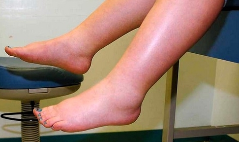 Сердечные отеки ног у пожилых людей: симптомы и признаки опасной патологии