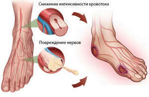 Причины полинейропатии нижних конечностей