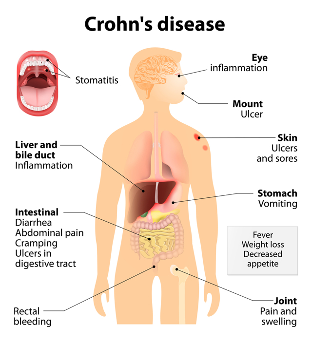 Болезнь Крона: симптомы, диагностика и лечение в домашних условиях