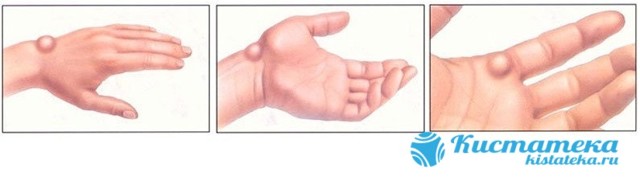 Синовиальная киста на пальце руки: симптоматика и методы диагностики