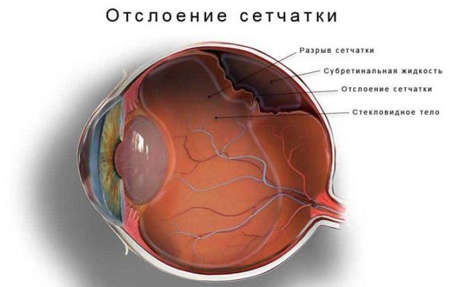 Послеоперационный период после замены хрусталика глаза при катаракте