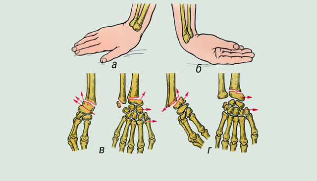 Бурсит кисти руки: причины возникновения и диагностика болезни