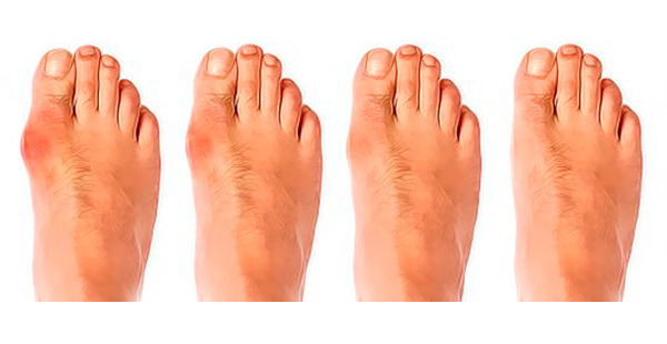 Симптомы бурсита большого пальца ноги: болевые ощущения и отечность конечностей