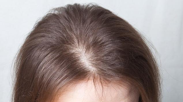 Сильное выпадение волос на голове у пожилых женщин - как и почему?
