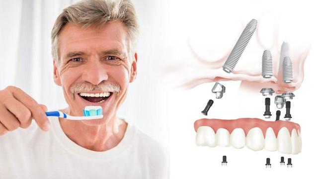 Правда или вымысел – все зубы за 1 день? Технология протезирования all-on-4