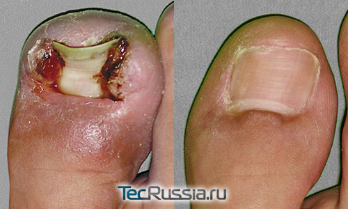 Лазерное удаление вросшего ногтя: причины появления недуга и как проходит процедура