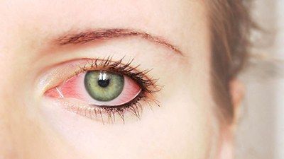 Причины и диагностика кератита глаза - симптомы, лечение и профилактика