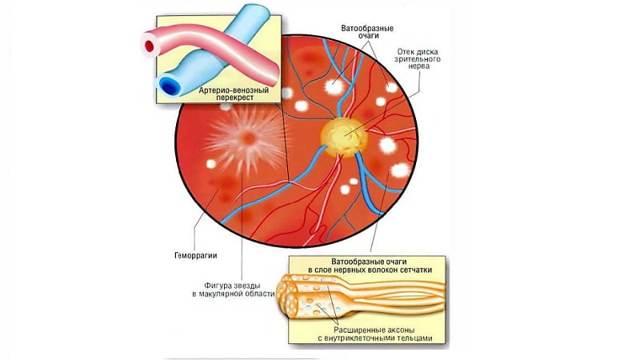 Гипертоническая ангиопатия сетчатки глаза: симптомы и лечение