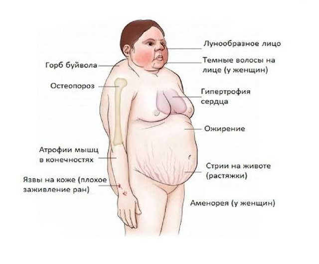 Болезнь Иценко-Кушинга: диагностика и процесс оздоровления