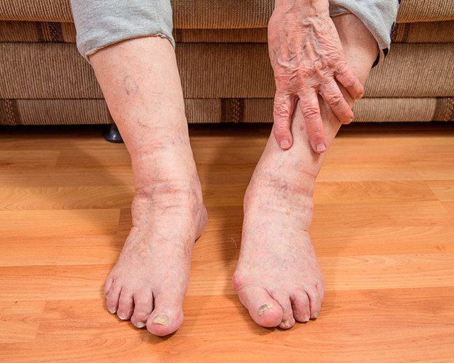 Ампутация ноги при гангрене в пожилом возрасте: как избежать печального исхода