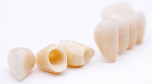 Виды зубных протезов: классификация