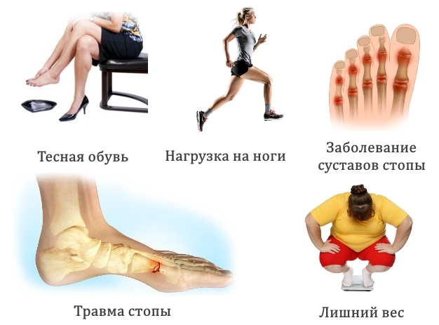 Основные симптомы гигромы стопы: болевые ощущения и постепенное увлечение размеров