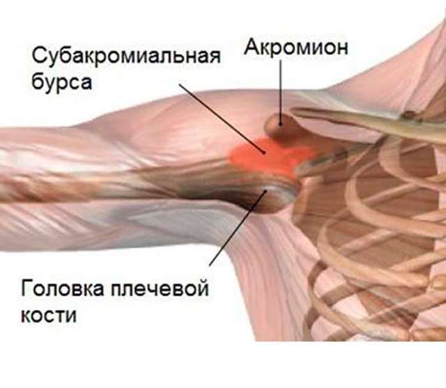 Причины развития субакромиального бурсита плечевого сустава: профессии подверженные патологии