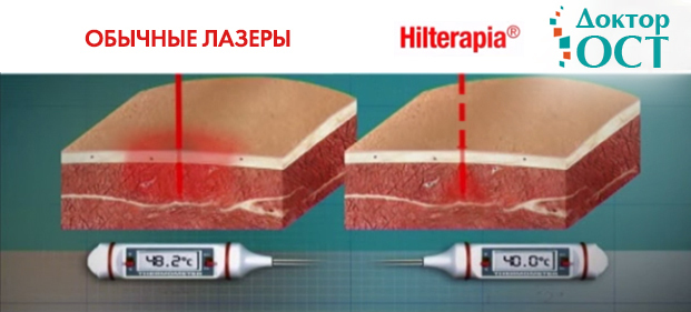 Хилт (hilt) терапия: лечение лазером высокой интенсивности