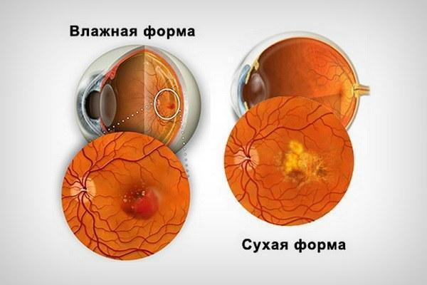 Макулодистрофия сетчатки глаза: влажная и сухая форма