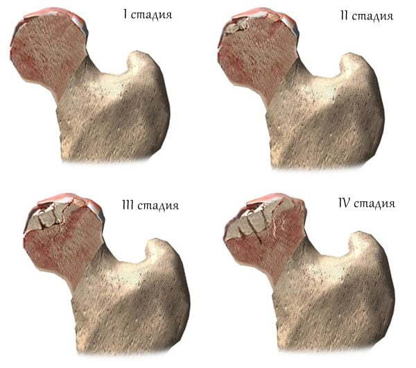 Степени артроза тазобедренного сустава: 1, 2, 3 и особенности каждой стадии