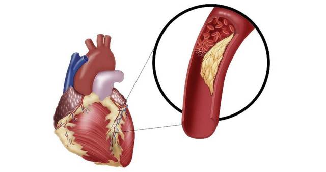 Ишемическая болезнь сердца у пожилых: симптомы и лечение