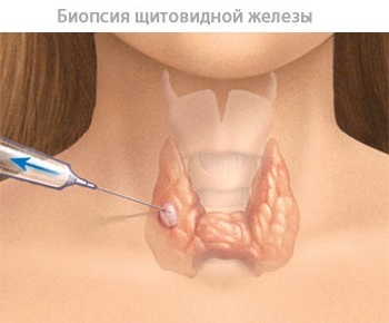 Узловой зоб щитовидной железы: симптомы и лечение