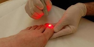 Как лечить онихокриптоз ногтей: медикаменты, ванночки, хирургическое вмешательство и народная медицина