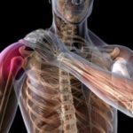 Как правильно лечить артроз плечевого сустава: операция, гимнастика и народные методы