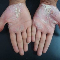 Псориаз на руках: диагностика и лечение