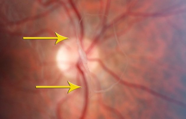 Отслойка сетчатки глаза: причины, симптомы и лечение