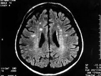 Первые симптомы синдрома Крейтцфельдта-Якоба: снижение памяти и остроты зрения