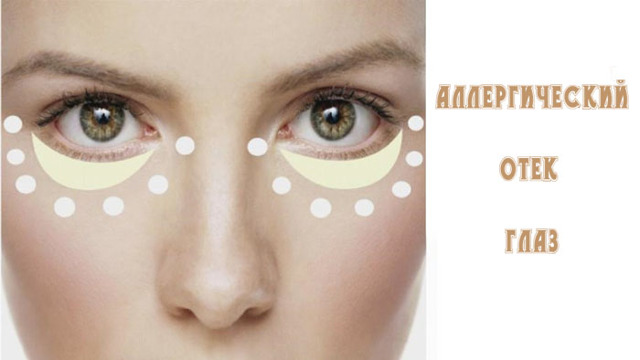 Аллергическая реакция на глазах: симптомы и диагностика