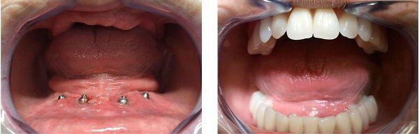 Протезирование зубо по методу all-on-4 в в медицинских клиниках Литвы: преимущества процедуры