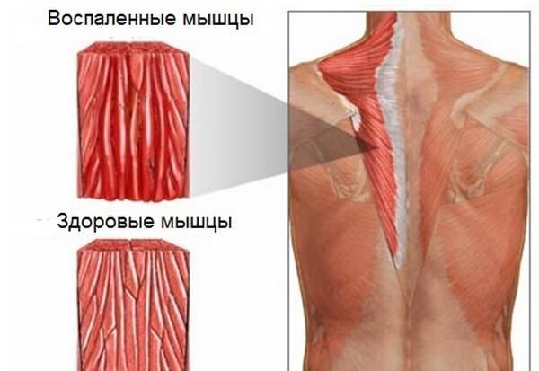 Причины развития миозита шейных мышц: переохлаждение, инфекция и травмы