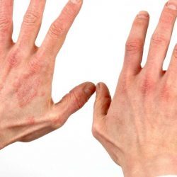 Псориаз на руках: диагностика и лечение