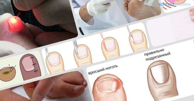 Лазерное удаление вросшего ногтя: причины появления недуга и как проходит процедура