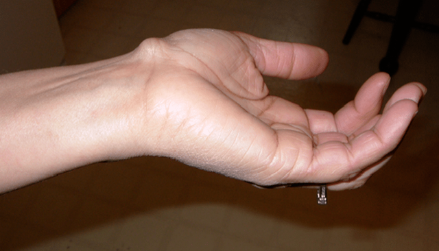 Бурсит кисти руки: причины возникновения и диагностика болезни
